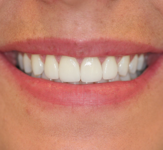 Katie Crosby: Perfect Teeth